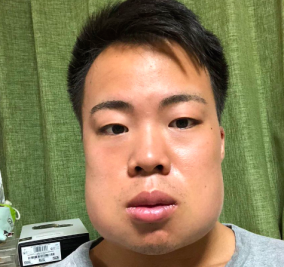 親知らずを一度に4本抜いた学生ボディビルダーの顔面が話題