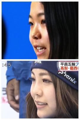 スキージャンプ高梨沙羅が大幅整形し話題