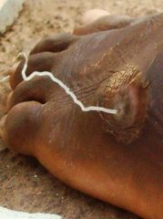 147269-guinea-worm-4-tamale-ghana.jpg