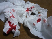 20110802-nosebleed2.jpg