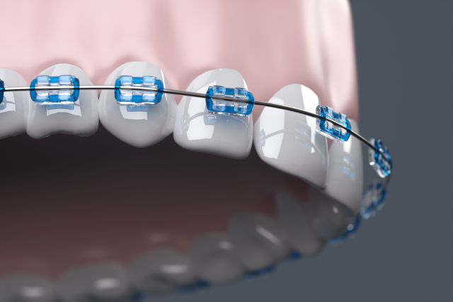 歯列矯正の器具をつけている歯の模型
