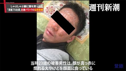 顔にやけどを負った男性