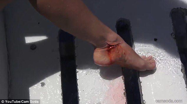 サメに噛まれたモリー・キャバリの足