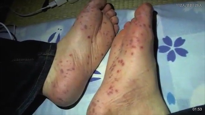 発疹がある足の裏